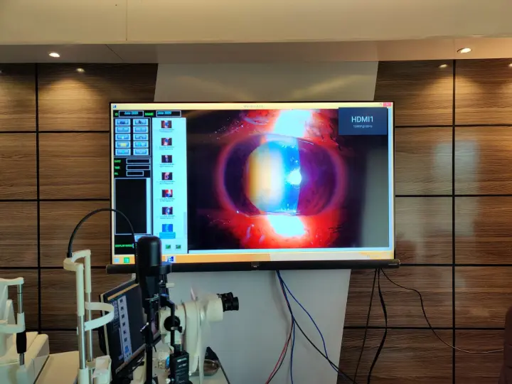 Slit lamp camera showing a magnified view of the front of an eye on a large screen.